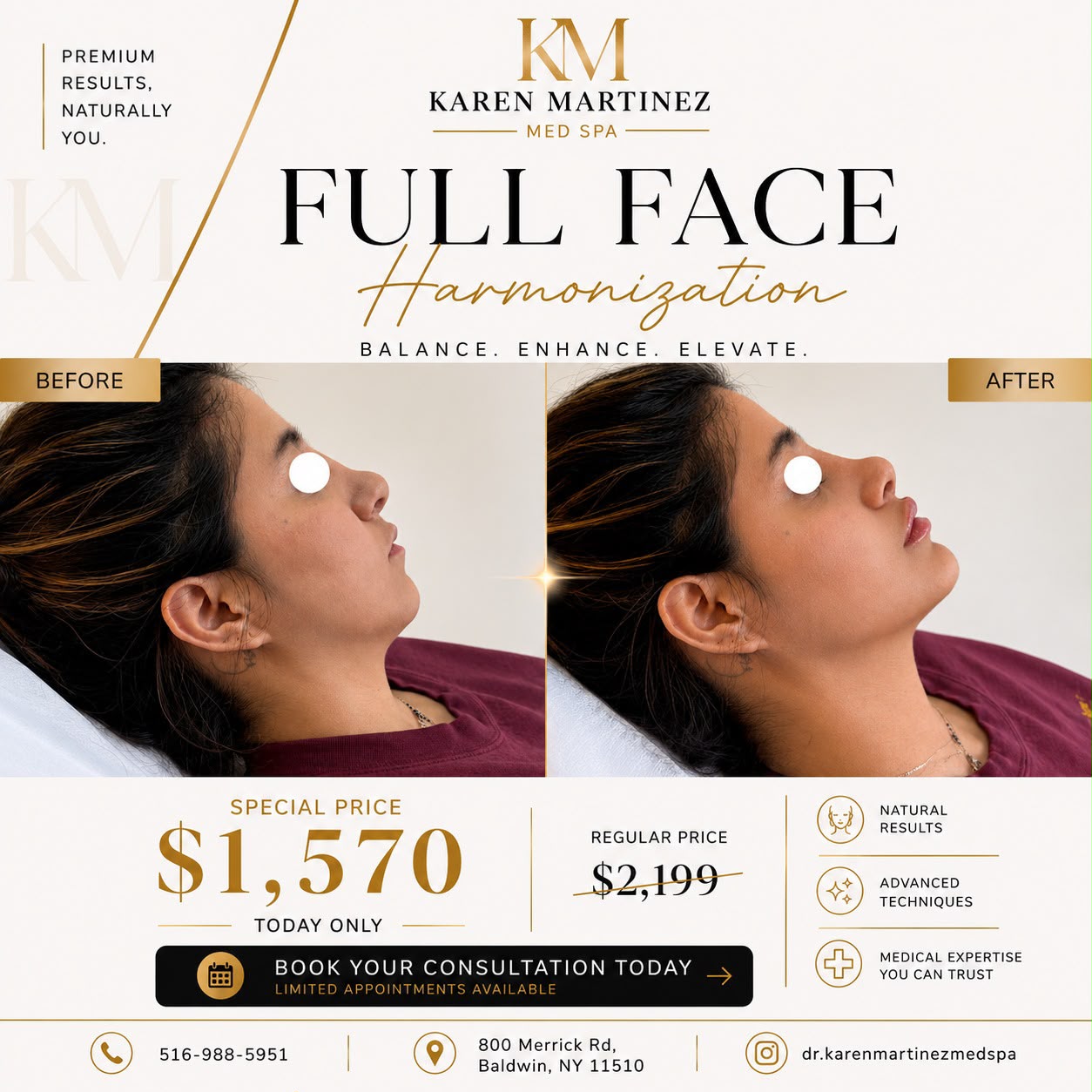 Full Face Harmonization — Special Price $1,570